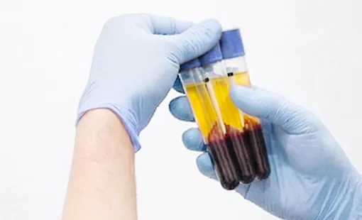 PRP治療のイメージ｜銀座YRクリニックの再生医療