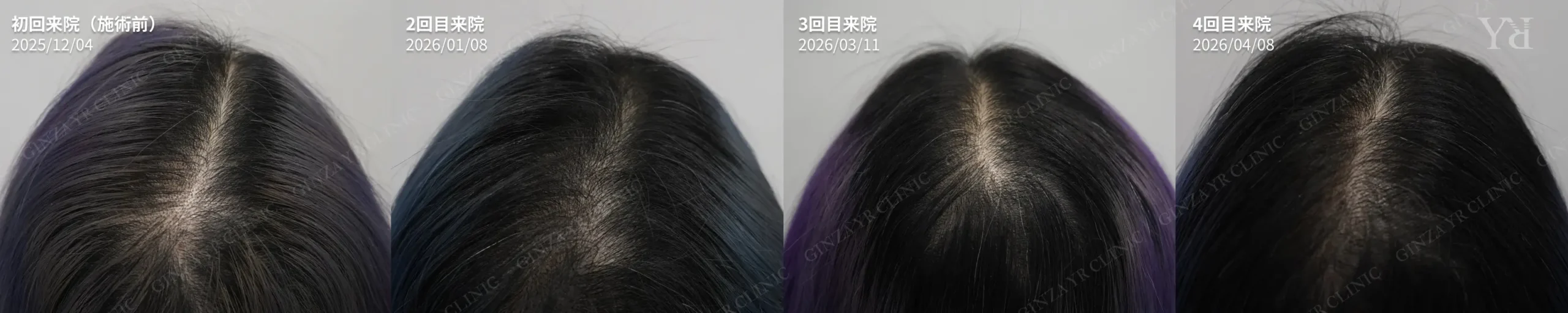 37歳女性 FAGA 髪の分け目 背面 セクレトーム導入4回の経過 銀座YRクリニック