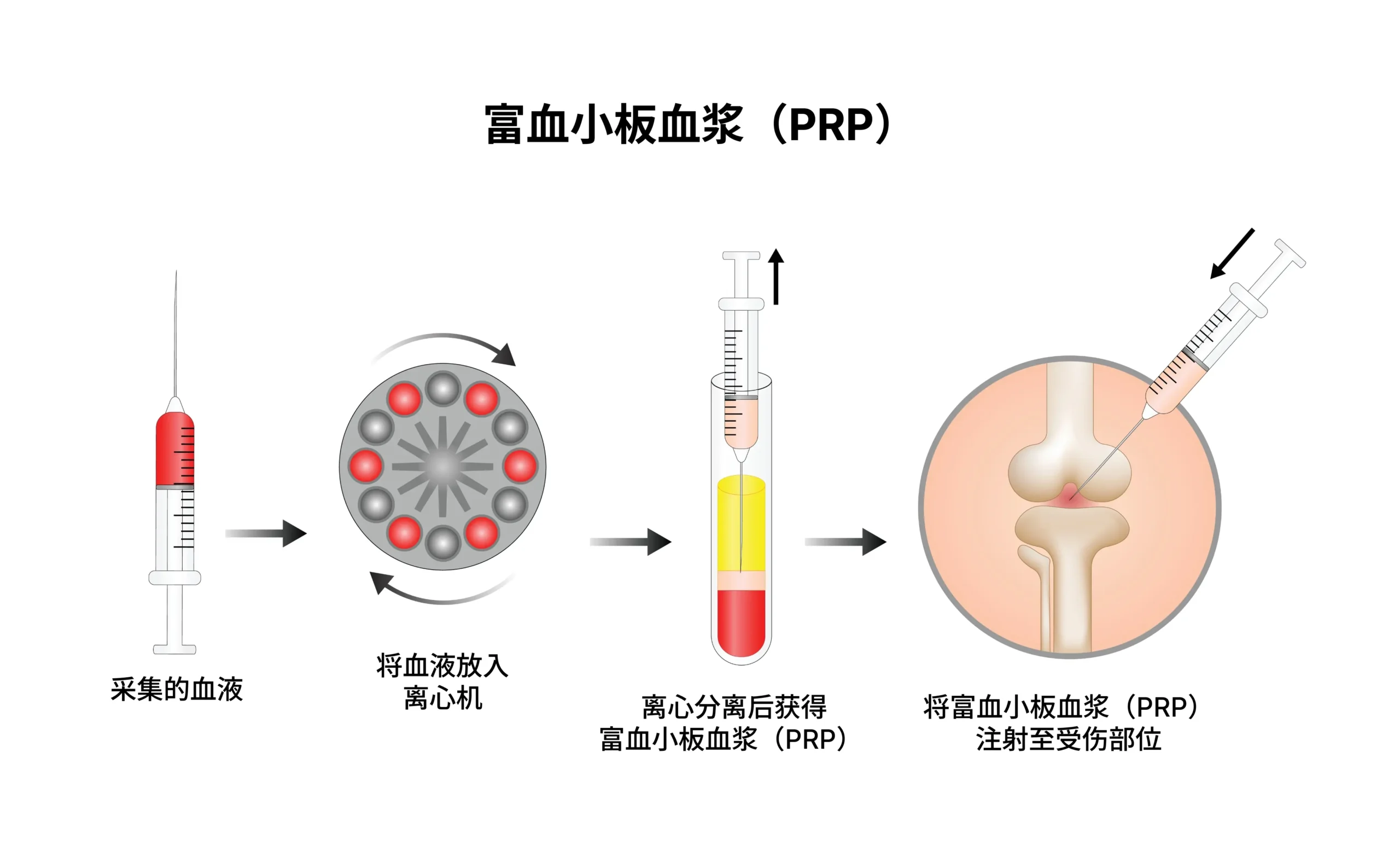 PRP的制备|通过离心浓缩血小板 离心分离制备PRP 浓缩血小板血浆 银座YR诊所