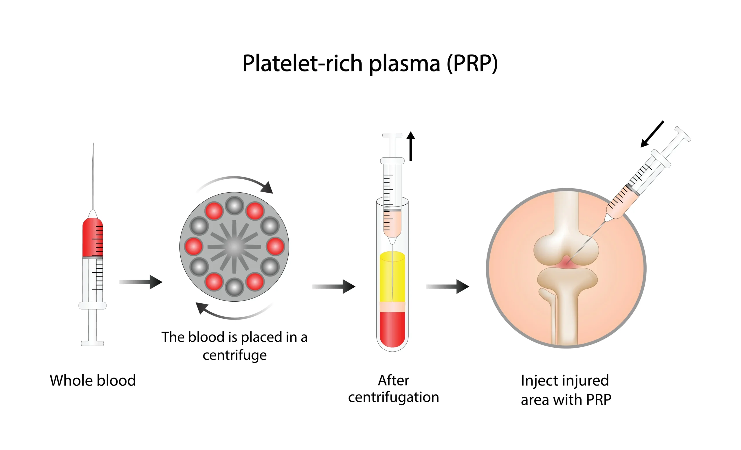Centrifuge separating platelet-rich plasma for PRP preparation at Ginza YR Clinic