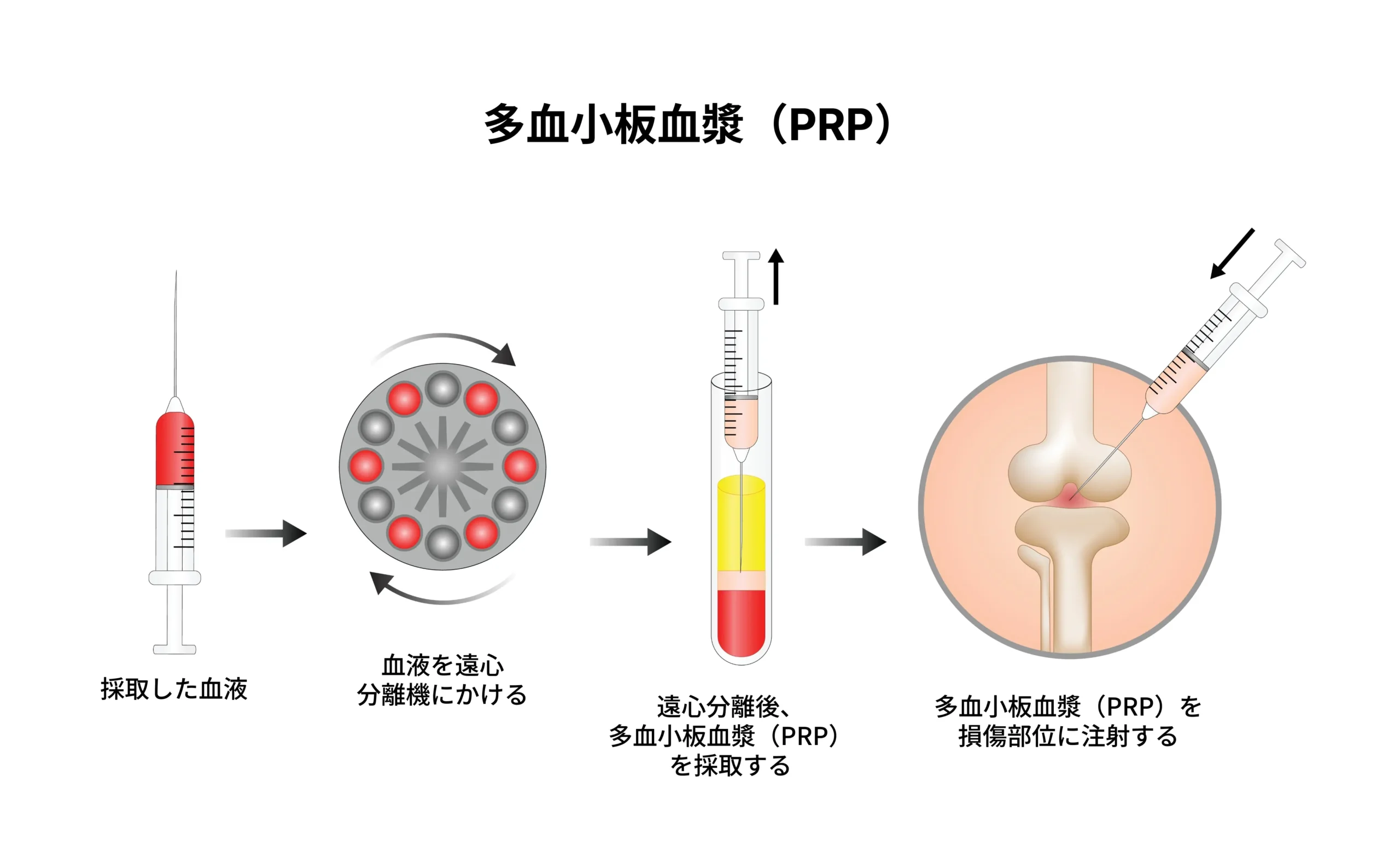 PRPの作製|遠心分離による血小板の濃縮 遠心分離によるPRP作製 血小板を濃縮した血漿 銀座YRクリニック